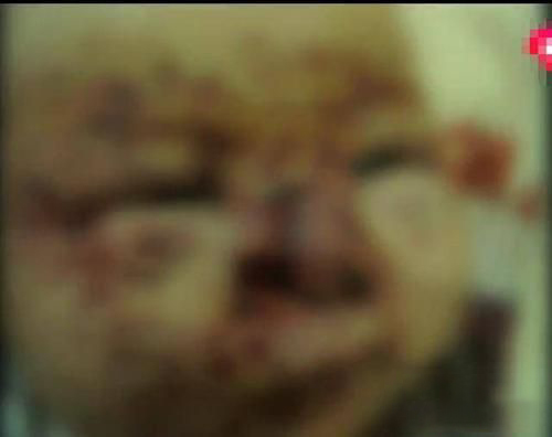 梦见被老鼠咬脸