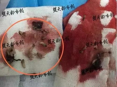 梦见从自己肉里拽出蛆