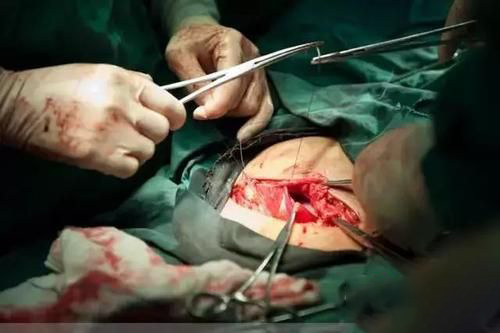 梦见剖腹生孩子