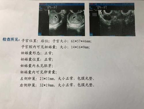 梦到自己孕期做流产