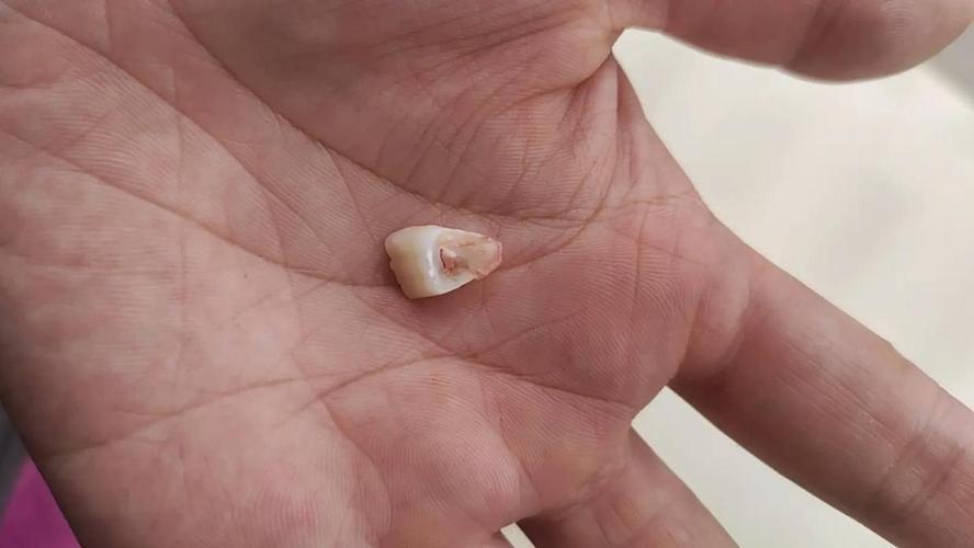 梦见牙齿松动快要掉了