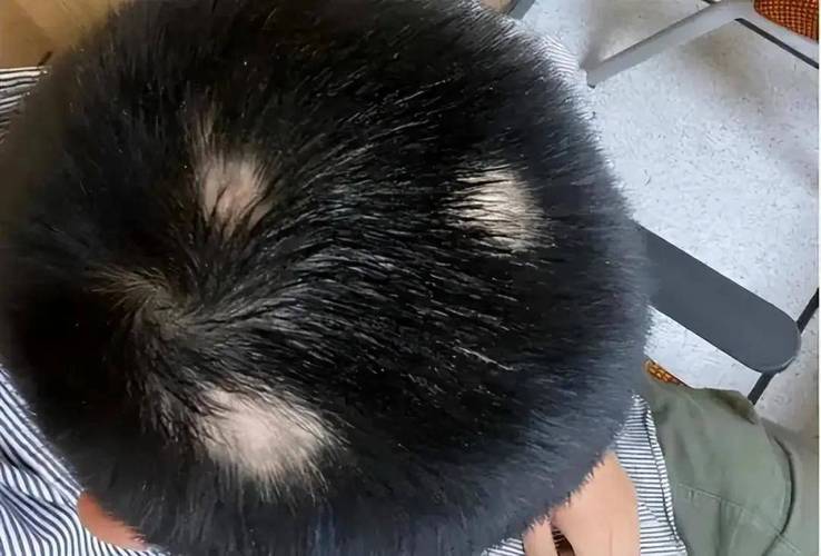 女人梦见自己头顶中间秃了一块